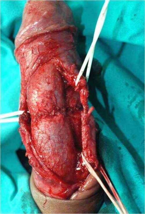 Penile fracture. Repair of the left corpus cavernosum. Penile fracture is a traumatic rupture of tunica albuginea and the tumescent corpora cavernosa due to the nonphysiological bending of the penile shaft, presenting with or without rupture of...