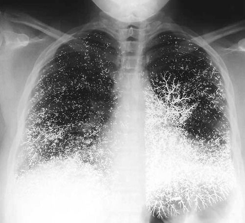 Mercury embolism to the lung A 21-year-old dental assistant attempted suicide by injecting 10 ml (135 g) of elemental mercury intravenously. She presented to the emergency room with tachypnea, a dry cough, and bloody sputum. A chest radiograph showed...