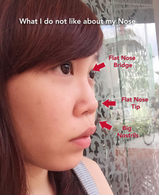 My Rhinoplasty (Nose Surgery) Journey 1: Chloe's Beauty Diary – Science of  Pretty